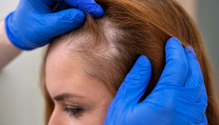 Cara Menumbuhkan Rambut dengan Cepat dan Sehat