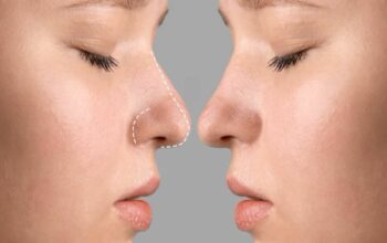 Rhinoplasty: Solusi Hidung Ideal dan Napas Lega Sekaligus
