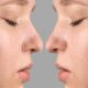 Rhinoplasty: Solusi Hidung Ideal dan Napas Lega Sekaligus